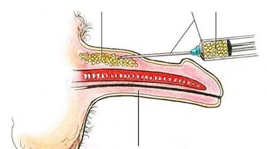 Méthode chirurgicale pour augmenter le membre