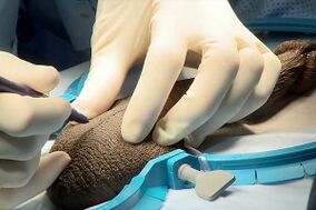 incision de moucheron pour l'agrandissement chirurgical du pénis