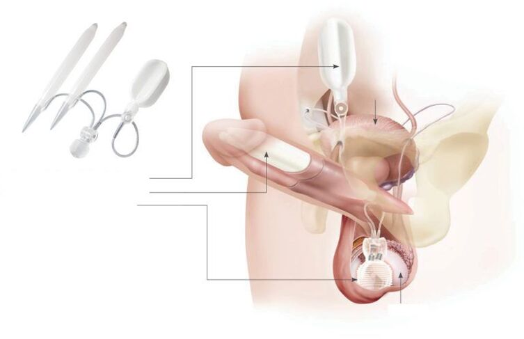 implants de gel dans le pénis